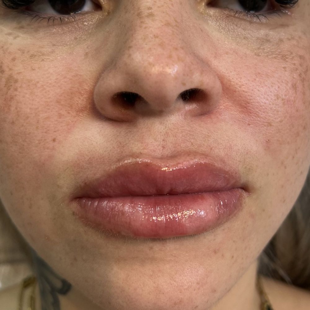 Depois — preenchimento labial